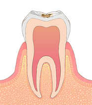 C1：歯の表面（エナメル質内）の虫歯