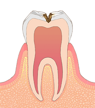 C2：歯の内面（象牙質に達した）の虫歯