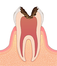 C3：歯の神経にまで達した虫歯