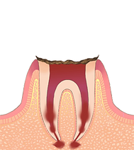 C4：歯の根元のみ残っている虫歯