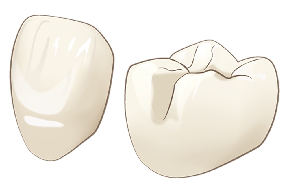 オールセラミック