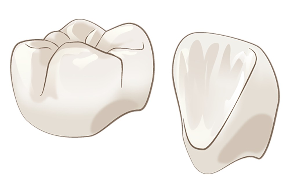 オールジルコニア