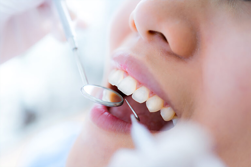 歯垢（プラーク）を除去